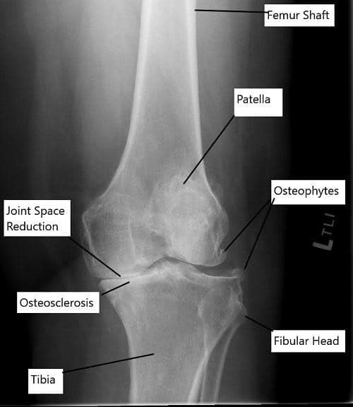 X-ray showing osteoarthritis of the knee. X-ray showing osteoarthritis of the knee.