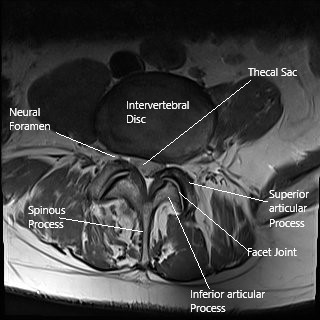 La cirugía de columna con láser se puede usar para tratar la hernia de disco intervertebral como se ve en esta sección de resonancia magnética axial de la columna lumbar. La cirugía de columna con láser se puede usar para tratar la hernia de disco intervertebral como se ve en esta sección de resonancia magnética axial de la columna lumbar.
