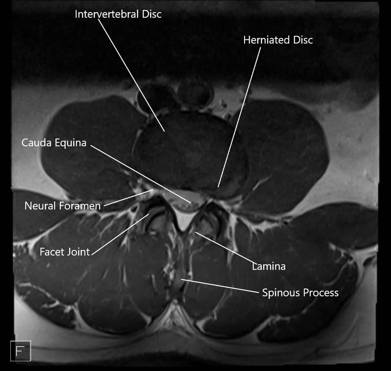 MRI showing herniated disc in axial section. MRI showing herniated disc in axial section.