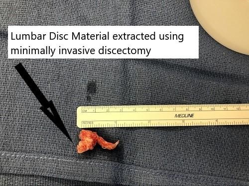 Intraoperative image showing the extracted disc material. Intraoperative image showing the extracted disc material.
