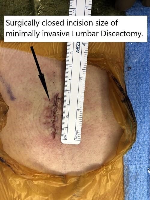Intraoperative image showing the surgical incision size of minimally invasive lumbar discectomy. Intraoperative image showing the surgical incision size of minimally invasive lumbar discectomy.