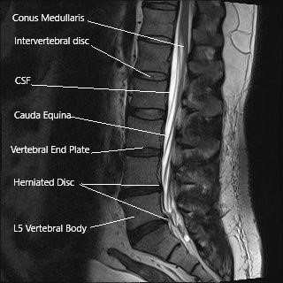 MRI showing sagittal section of the lumbar spine. MRI showing sagittal section of the lumbar spine.