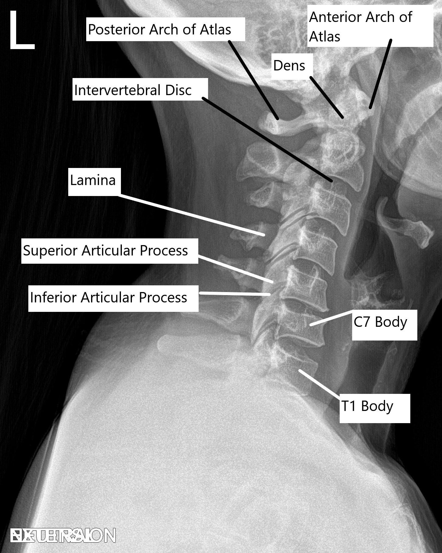 Cervical Spine X-ray in Lateral view. Cervical Spine X-ray in Lateral view.