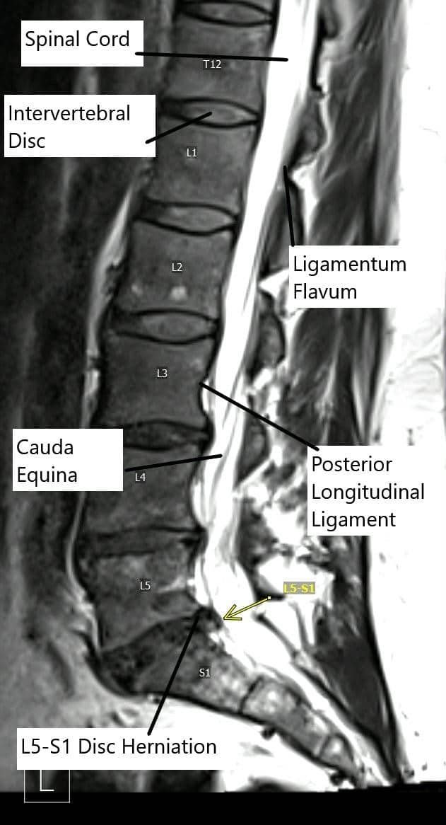 Sagittal section of the lumbar MRI showing L5-S1 disc herniation. Sagittal section of the lumbar MRI showing L5-S1 disc herniation.