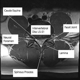 MRI image in axial section showing lumbar spine at the level of L5-S1. MRI image in axial section showing lumbar spine at the level of L5-S1.