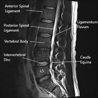 MRI image in sagittal section showing lumbar spine. MRI image in sagittal section showing lumbar spine.