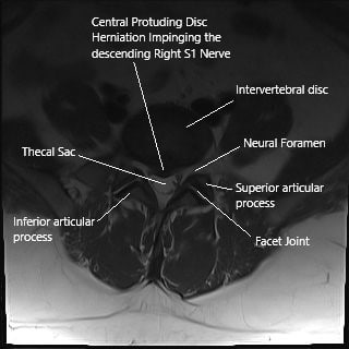 Axial section of the spine on MRI showing herniated intervertebral disc. Axial section of the spine on MRI showing herniated intervertebral disc.