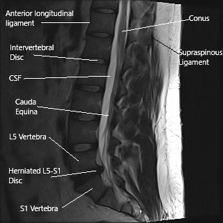 MRI of the lumbar spine in sagittal section showing herniated L5-S1 intervertebral disc. MRI of the lumbar spine in sagittal section showing herniated L5-S1 intervertebral disc.