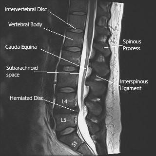 MRI image of the lumbosacral spine in sagittal section showing herniated intervertebral disc at L4-L5 level. MRI image of the lumbosacral spine in sagittal section showing herniated intervertebral disc at L4-L5 level.