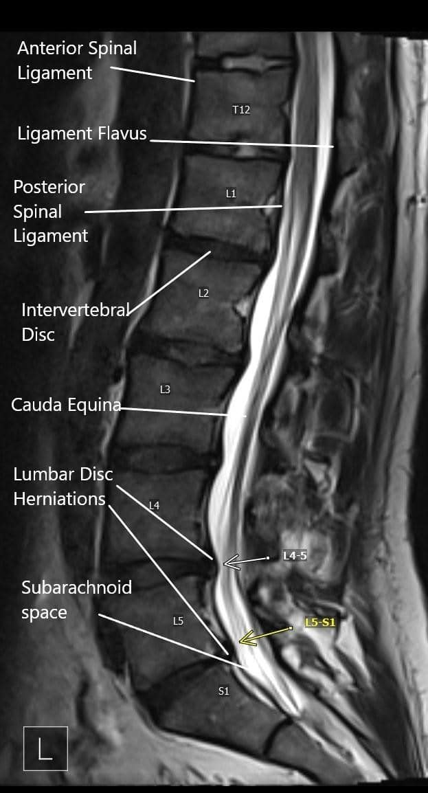 Sagittal section of the lumbosacral on MRI. Sagittal section of the lumbosacral on MRI.