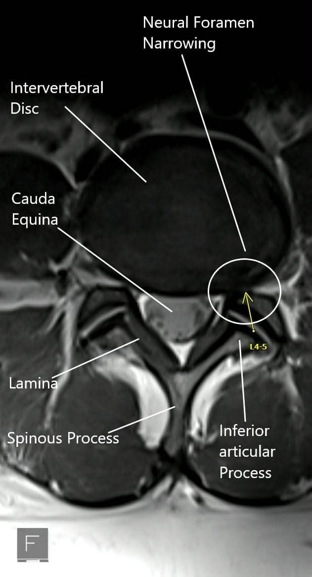 MRI showing the axial section of the lumbar spine with neural foramen narrowing. MRI showing the axial section of the lumbar spine with neural foramen narrowing.
