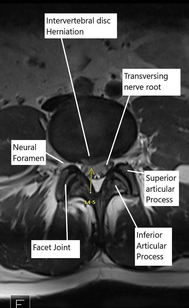 Axial section of the Lumbosacral MRI at L4-L5 level. Axial section of the Lumbosacral MRI at L4-L5 level.