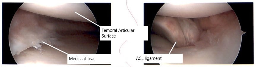 Intraoperative arthroscopic image of the left knee. Intraoperative arthroscopic image of the left knee.