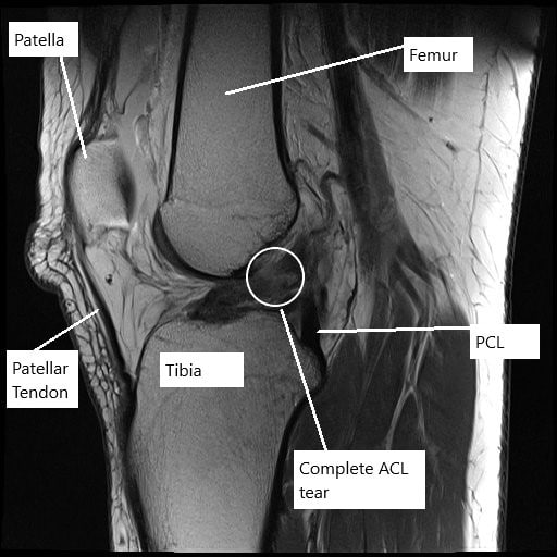 MRI of the left knee showing complete tear of the ACL. MRI of the left knee showing complete tear of the ACL.