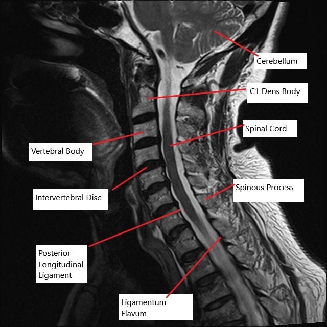 MRI of the cervical spine in the sagittal section showing multiple bulging intervertebral discs. MRI of the cervical spine in the sagittal section showing multiple bulging intervertebral discs.