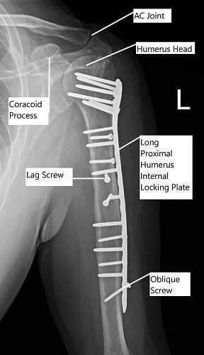 Post-operative x-ray of the left shoulder in AP view. Post-operative x-ray of the left shoulder in AP view.