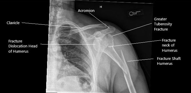 Pre-operative x-ray of the left shoulder in AP view. Pre-operative x-ray of the left shoulder in AP view.