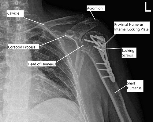 Post-operative x-ray of the left shoulder in AP view. Post-operative x-ray of the left shoulder in AP view.