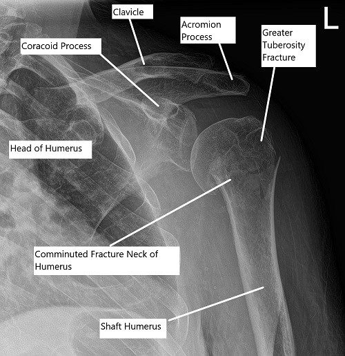 Pre-operative x-ray of the shoulder showing a three-part fracture of the proximal humerus. Pre-operative x-ray of the shoulder showing a three-part fracture of the proximal humerus.