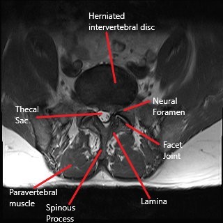 Axial section of MRI of the lumbar spine showing a herniated disc.