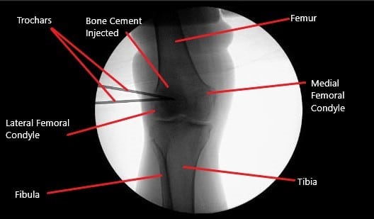 Imagen fluoroscópica intraoperatoria de la rodilla derecha que muestra inyección de fosfato tricálcico óseo. Imagen fluoroscópica intraoperatoria de la rodilla derecha que muestra inyección de fosfato tricálcico óseo.