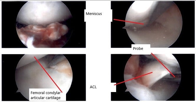 Intraoperative arthroscope image of the right knee. Intraoperative arthroscope image of the right knee.