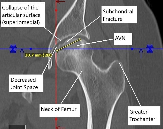Non-contrast CT image showing AVN changes in the left head of the femur. Non-contrast CT image showing AVN changes in the left head of the femur.