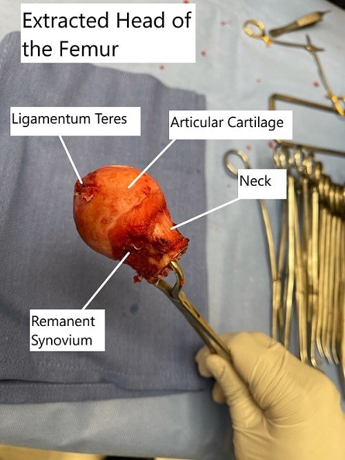 Intraoperative extracted head of the femur with a coronal cut section showing the avascular necrotic area in the superior medial head. Intraoperative extracted head of the femur with a coronal cut section showing the avascular necrotic area in the superior medial head.