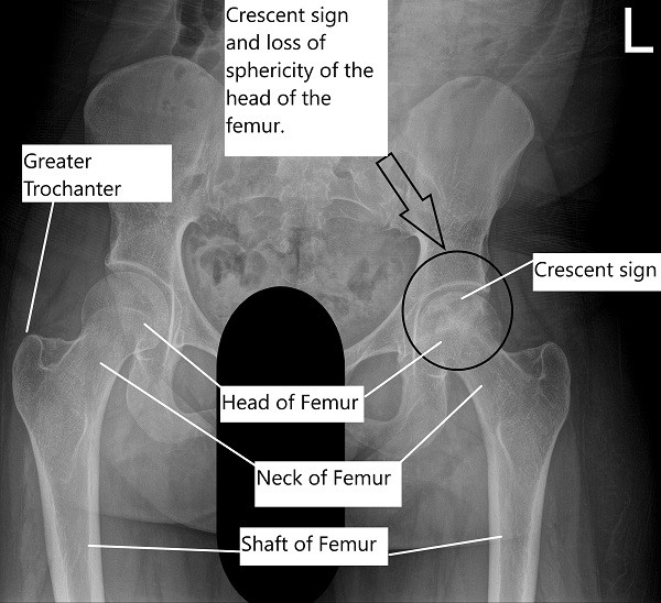 X-ray of the pelvis with both hip joints showing AVN of the left head of the femur. X-ray of the pelvis with both hip joints showing AVN of the left head of the femur.