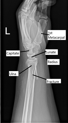 X-ray showing distal radius fracture in lateral view. X-ray showing distal radius fracture in lateral view.
