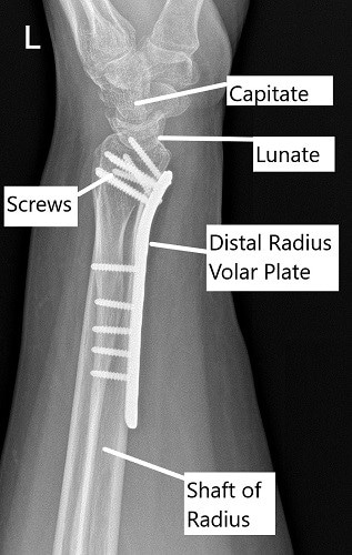 Post-operative x-ray of the wrist in lateral view. Post-operative x-ray of the wrist in lateral view.