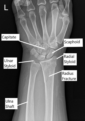 X-ray showing distal radius fracture in AP view. X-ray showing distal radius fracture in AP view.