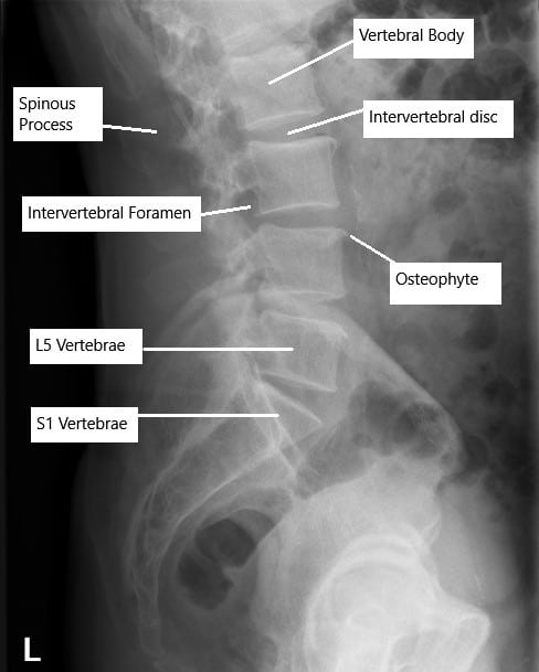 Radiografía de la columna lumbar que muestra cambios degenerativos. Radiografía de la columna lumbar que muestra cambios degenerativos.