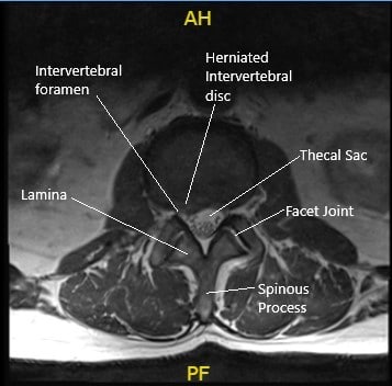 Sección de RM axial preoperatoria a nivel L2-L3 que muestra hernia discal.