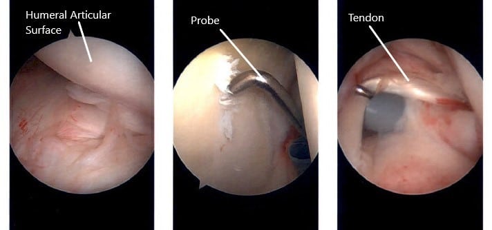 Intraoperative arthroscopic images of the left shoulder. Intraoperative arthroscopic images of the left shoulder.