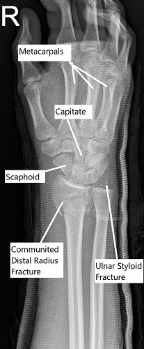 X-ray of the wrist in oblique view showing a comminuted fracture of the distal radius. X-ray of the wrist in oblique view showing a comminuted fracture of the distal radius.