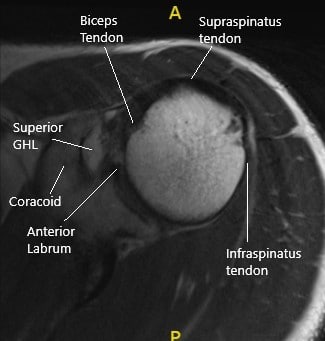 MRI of the left shoulder in axial section. MRI of the left shoulder in axial section.