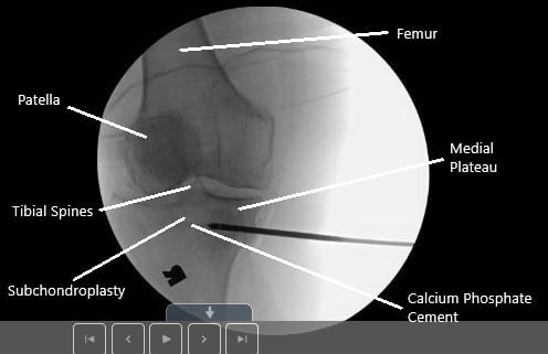 Intraoperative fluoroscopic image of subchondroplasty. Intraoperative fluoroscopic image of subchondroplasty.