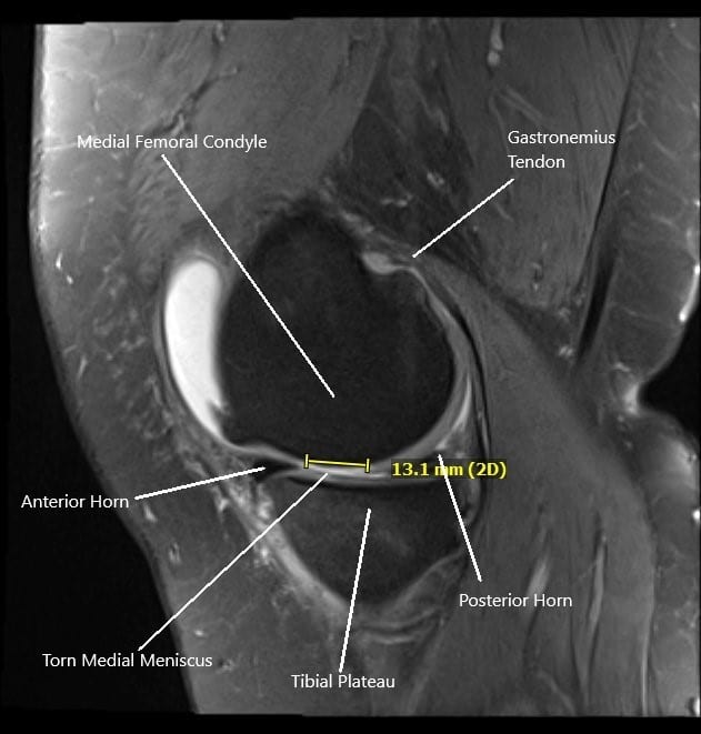 MRI of the right knee in sagittal section showing tear of the medial meniscus. MRI of the right knee in sagittal section showing tear of the medial meniscus.