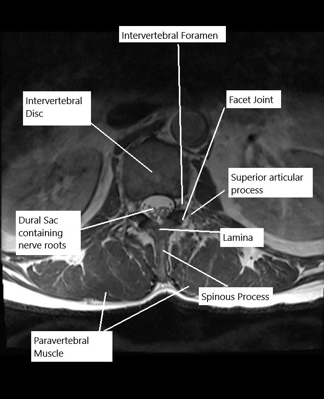 MRI of the lumbar spine in axial section.