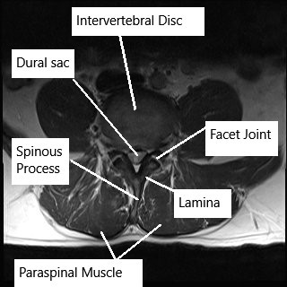 MRI of the lumbar spine in axial section. MRI of the lumbar spine in axial section.
