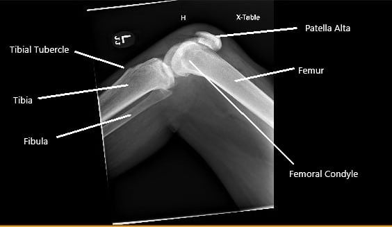 X-ray of the right knee showing patella Alta secondary to the rupture of the patellar tendon. X-ray of the right knee showing patella Alta secondary to the rupture of the patellar tendon.