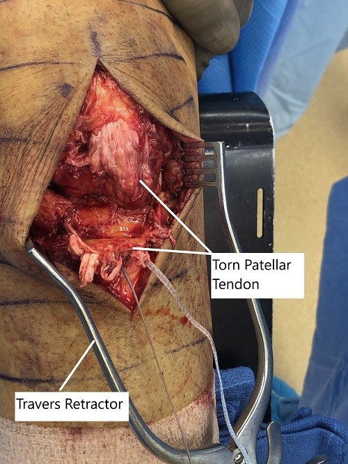 Intraoperative image showing the torn patellar tendon. Intraoperative image showing the torn patellar tendon.