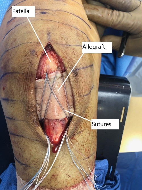 Intraoperative image showing the repaired patellar tendon with overlying allograft. Intraoperative image showing the repaired patellar tendon with overlying allograft.