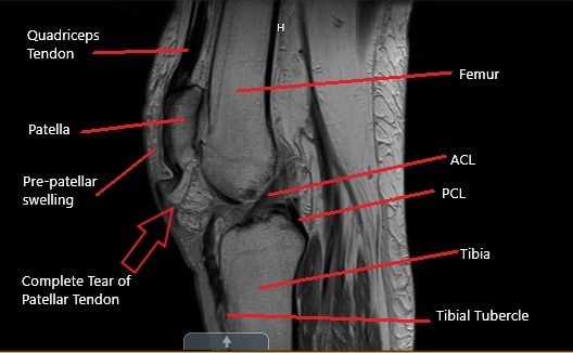 MRI of the knee in the sagittal section showing a complete tear of the patellar tendon. MRI of the knee in the sagittal section showing a complete tear of the patellar tendon.