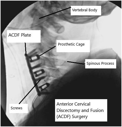 X-ray showing ACDF surgery. X-ray showing ACDF surgery.