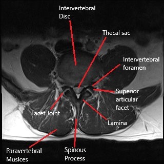 MRI of the lumbar spine in the axial section. MRI of the lumbar spine in the axial section.