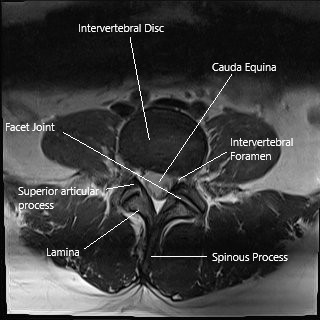 Resonancia magnética de la columna lumbar en sección axial.