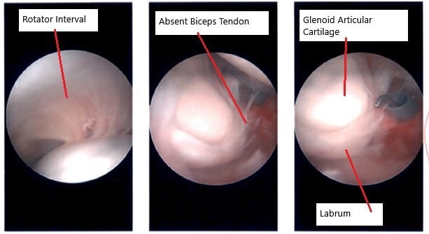 Intraoperative arthroscopic image of the shoulder. Intraoperative arthroscopic image of the shoulder.