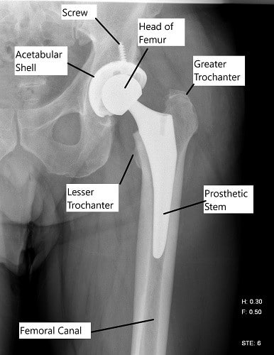 Radiografía que muestra un reemplazo total de cadera. Radiografía que muestra un reemplazo total de cadera.